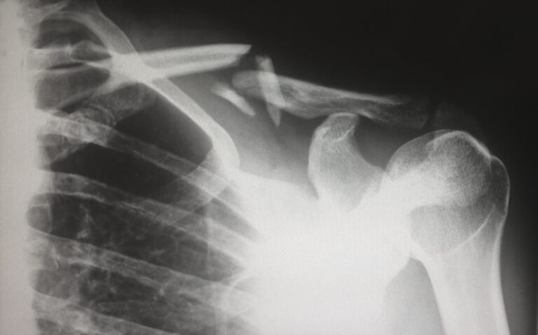 Person with arm in a sling recovering from shoulder surgery